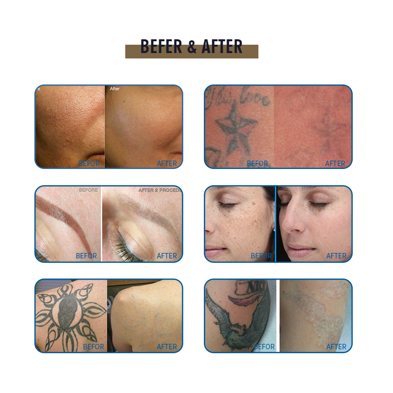 High Quality Picosecond Laser Machine Laser Picosecond De 500w Con Brazo Articulado Technology Tattoo Removal Pico Laser Machine