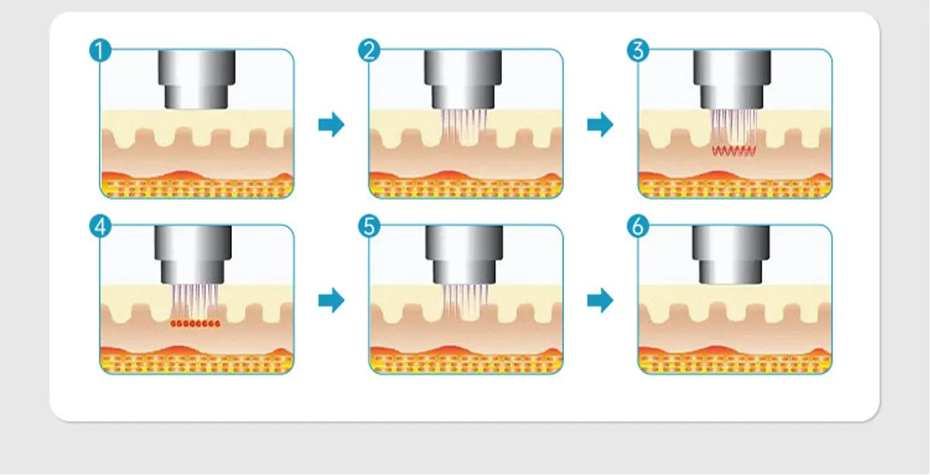 RF Microneedling Procedure