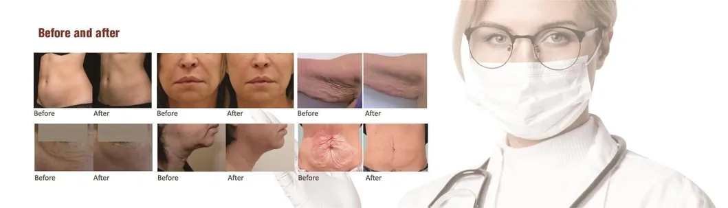 Wrinkle Removal Skin Tightening Hifu RF Skin Tightening Machine
