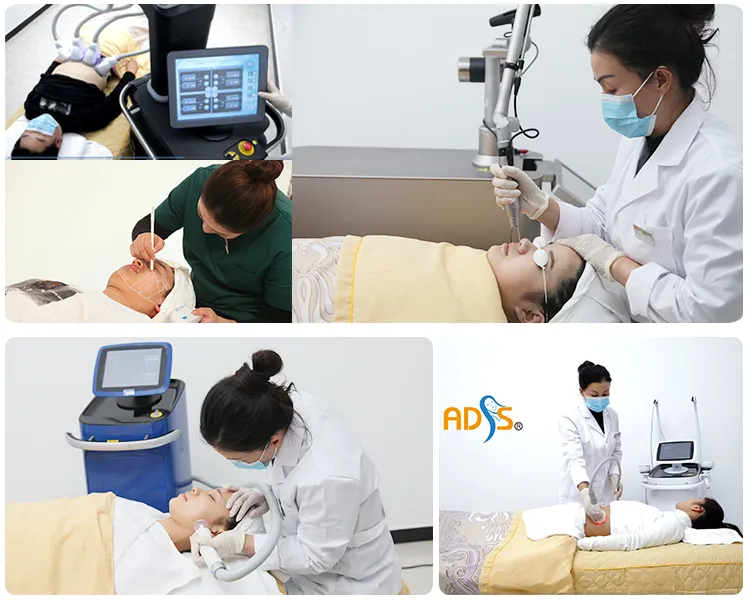 Multi-polar RF Treatment Demonstration on Skin Surface