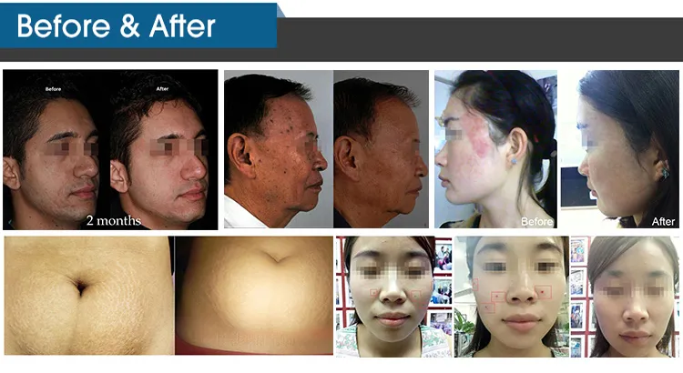 Factory-Direct CO2 Fractional Laser for Beauty Clinics and Spas