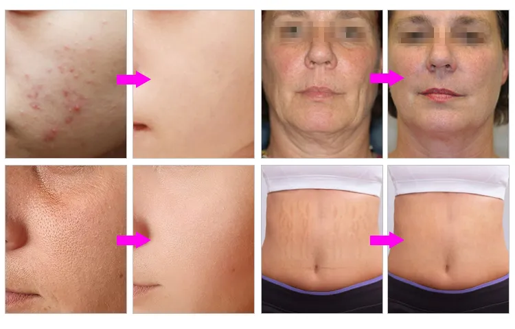 Before & After treatment result of 2in1 Gold RF Fractional Microneedle Machine