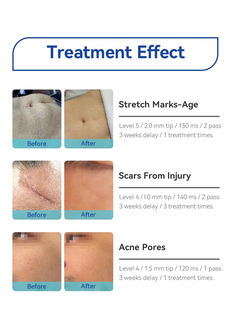 Portable Microneedle RF Skin Tightening Fractional RF Microneedling Machine
