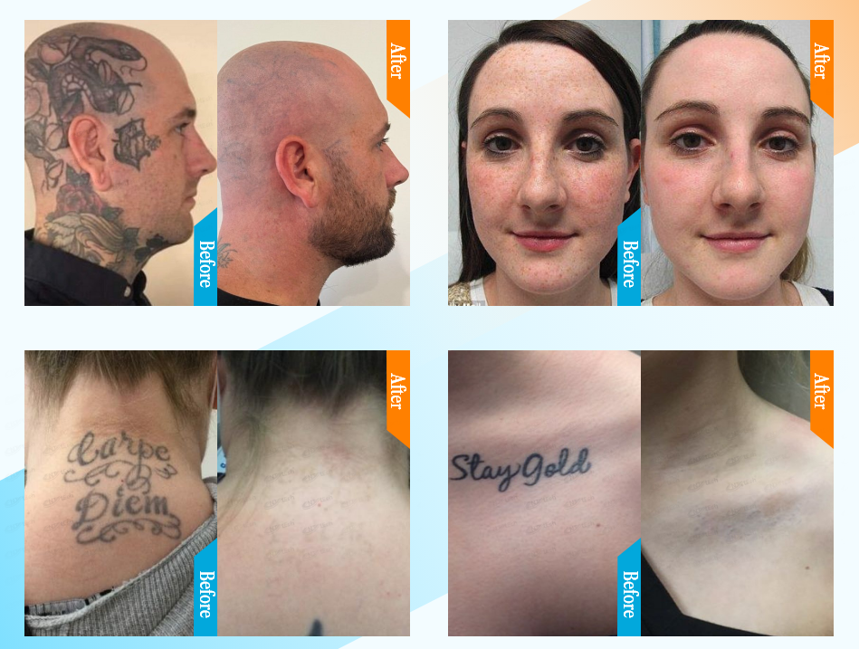 Before and After Results
