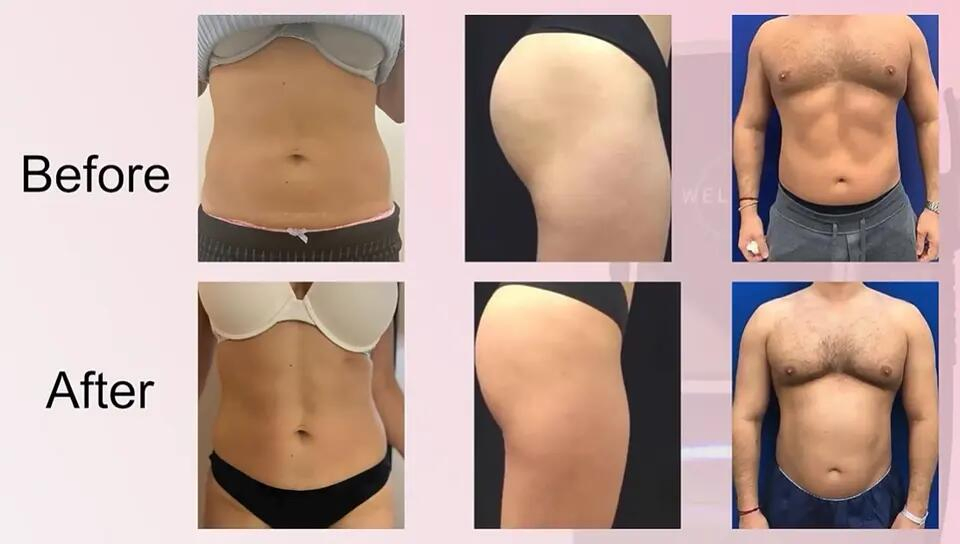 2026 Newest 15 Tesla 4 Handles EMS Body Sculpting Machine for Muscle Building and Fat Removal