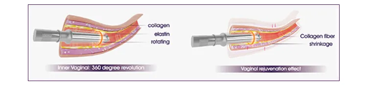 Vaginal Tightening Working Principle