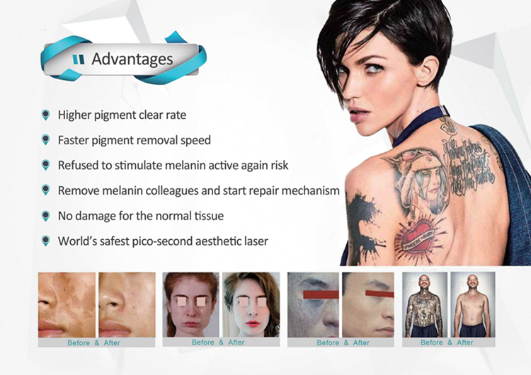 Epidermal pigment removal before after