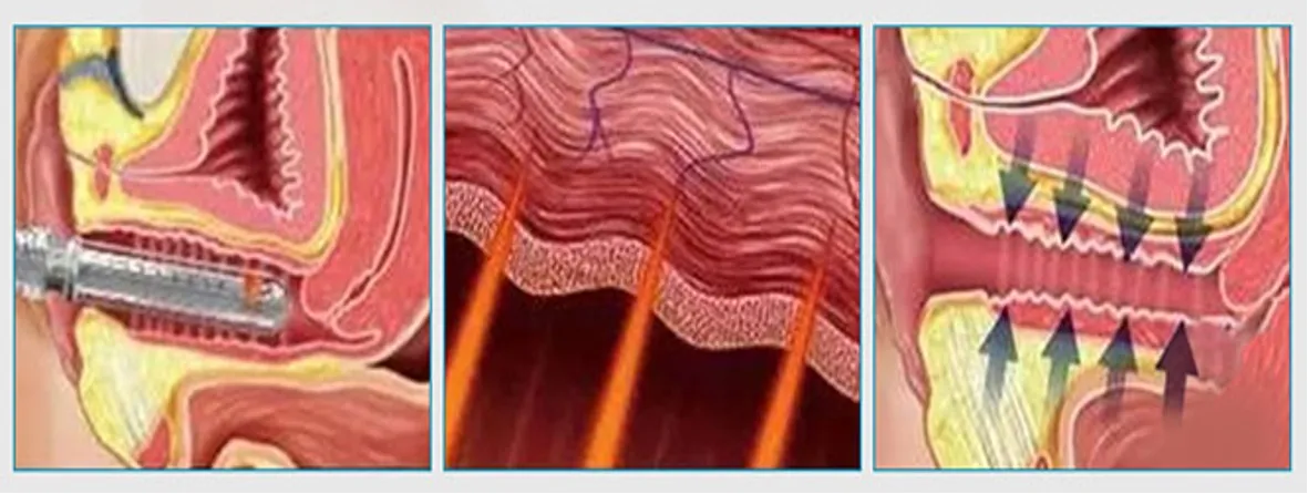 Vaginal Treatment Principle