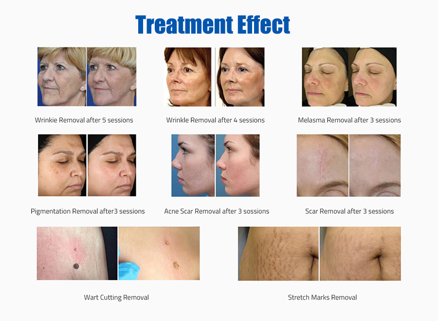 Usfda 510K Approved Fractional CO2 Laser for Skin Resurfacing Stretch Mark Scar Laser Removal Vaginal Rejuvenation