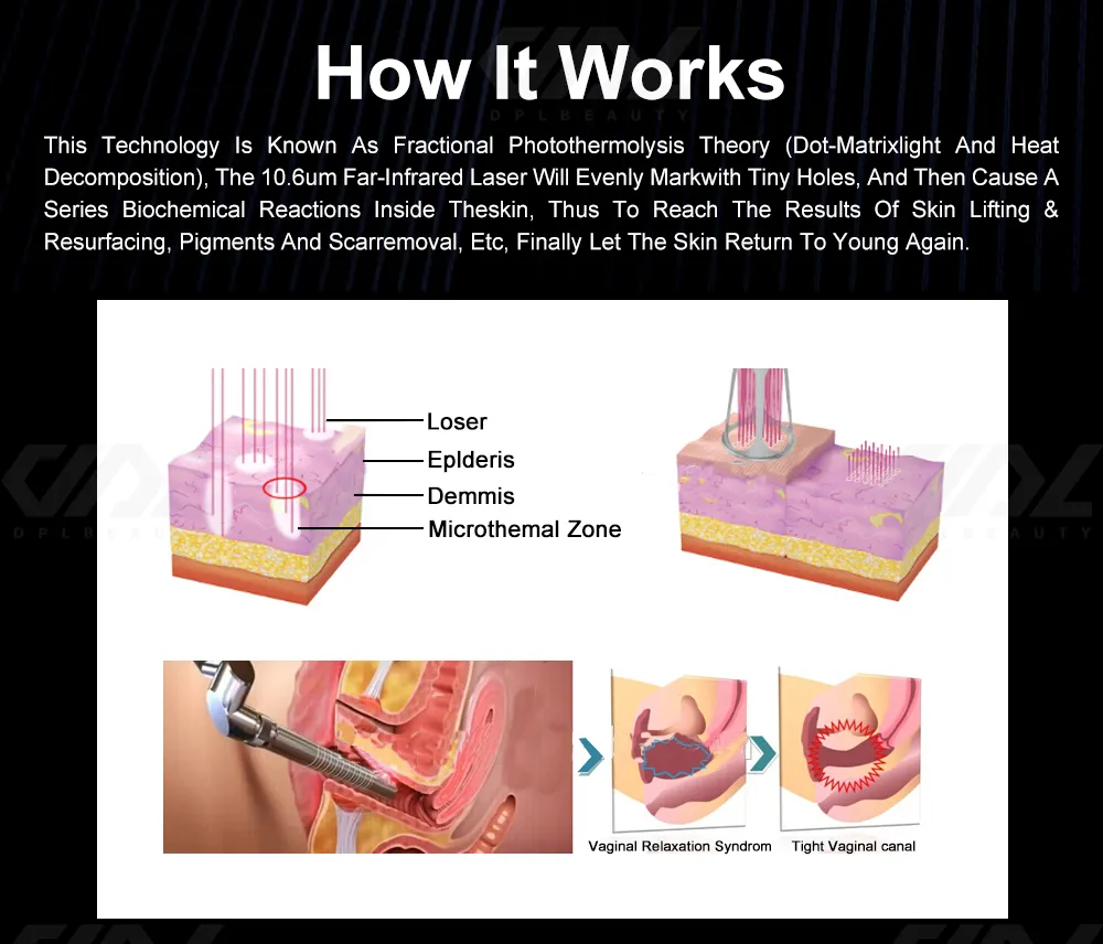 Fractional CO2 Laser Machine Details 7