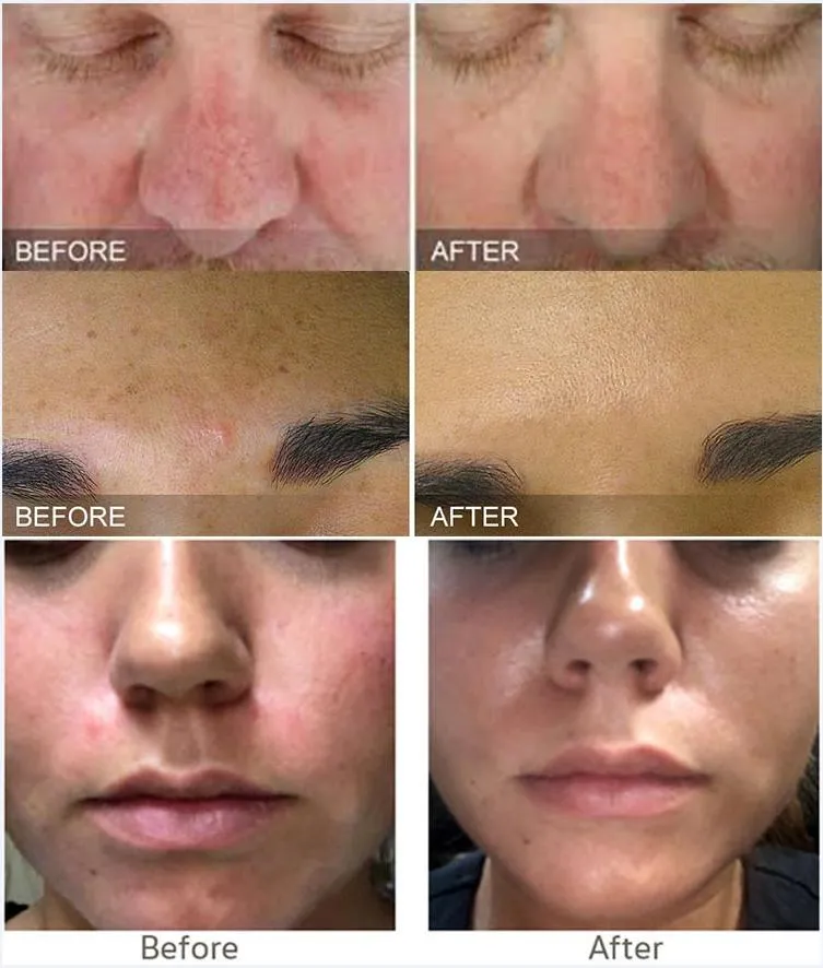 Before and After Treatment 1