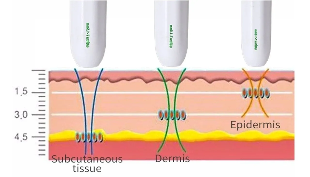 V-Max Treatment Mechanism