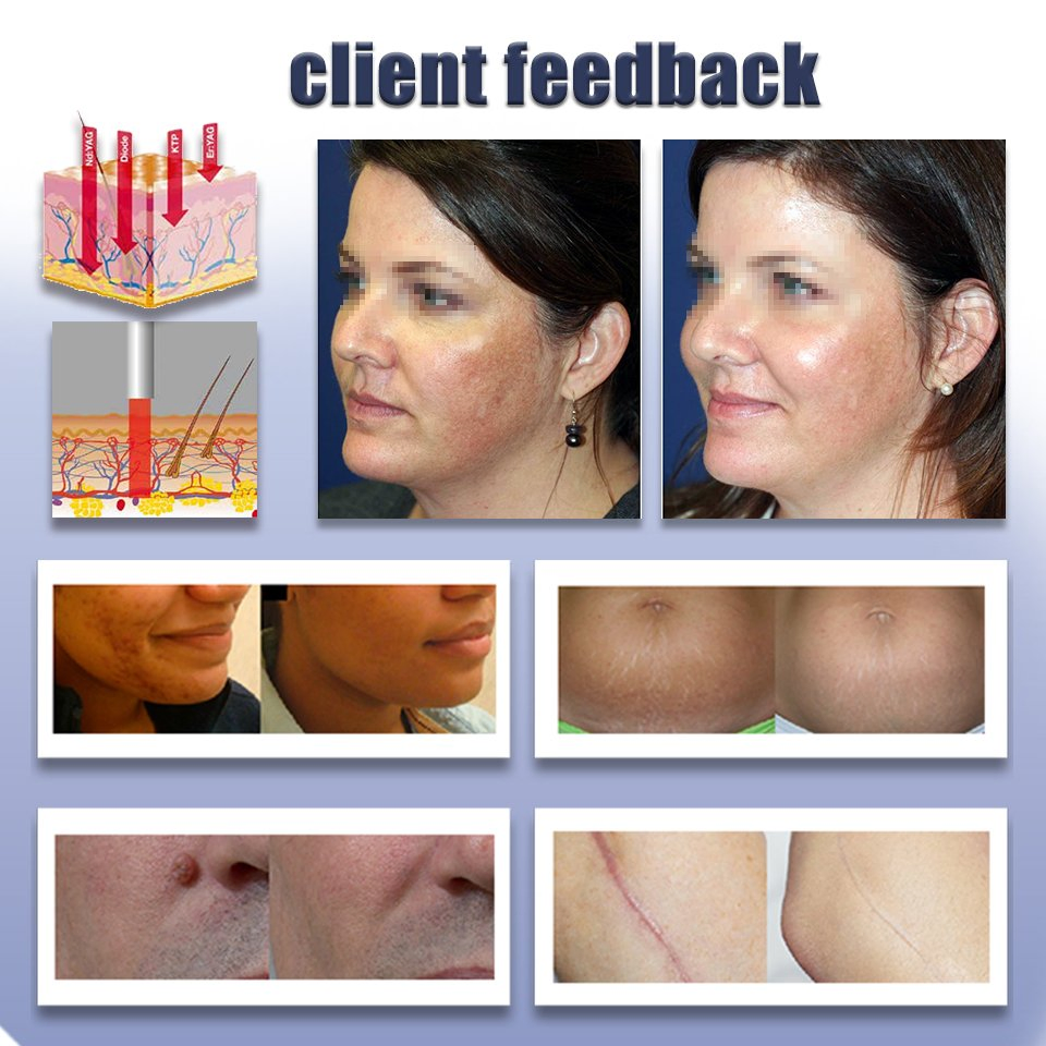OEM CO2 Laser Beauty Machine 10600nm Fractional Acne Freckles RF Skin Tightening CO2 Fractional Laser Machine