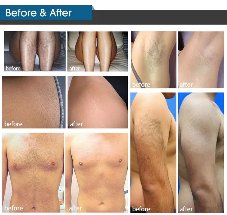 Diode Laser Hair Removal Wavelengths Medical Equipment