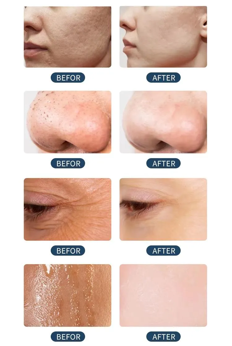 Hydro Microdermabrasion Oxygen Jet Aqua Facials Machine