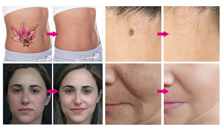Tattoo removal before and after comparisons