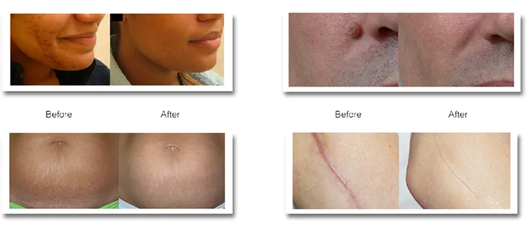 OEM CO2 Laser Beauty Machine 10600nm Fractional Acne Freckles RF Skin Tightening CO2 Fractional Laser Machine