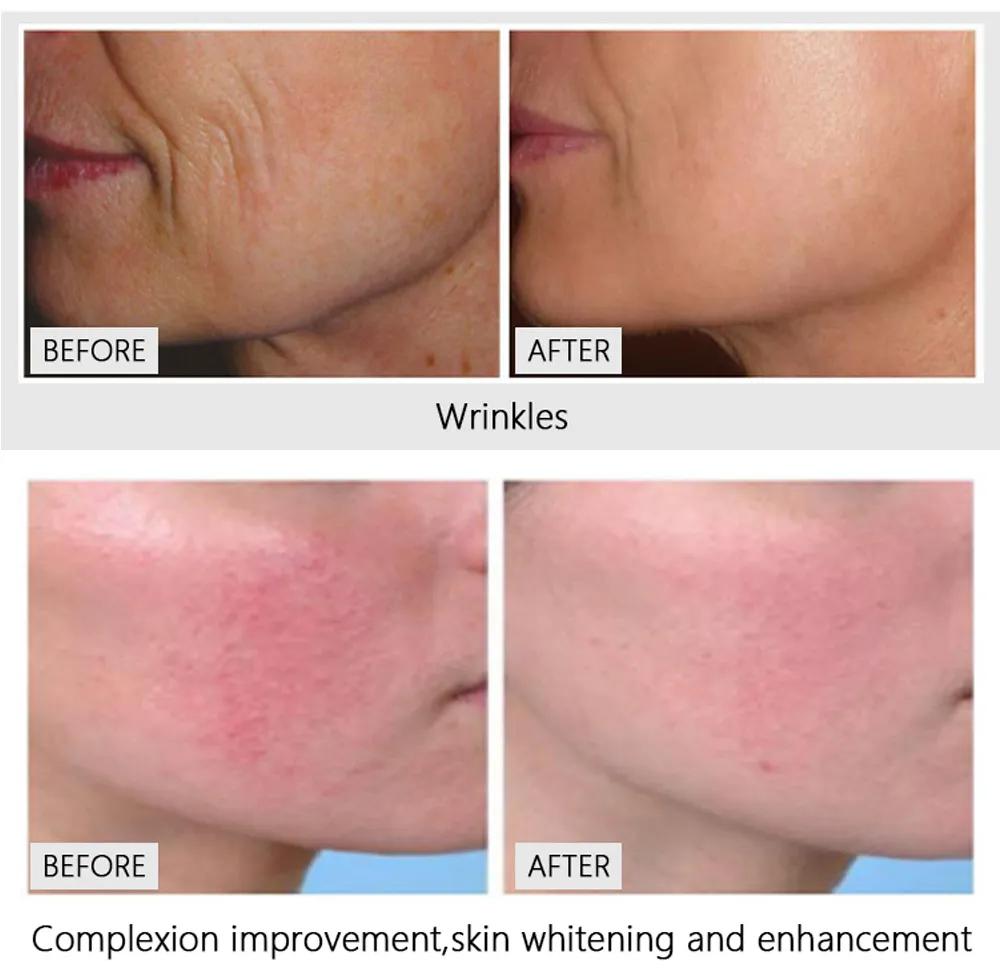 Laser CO2 Fractional