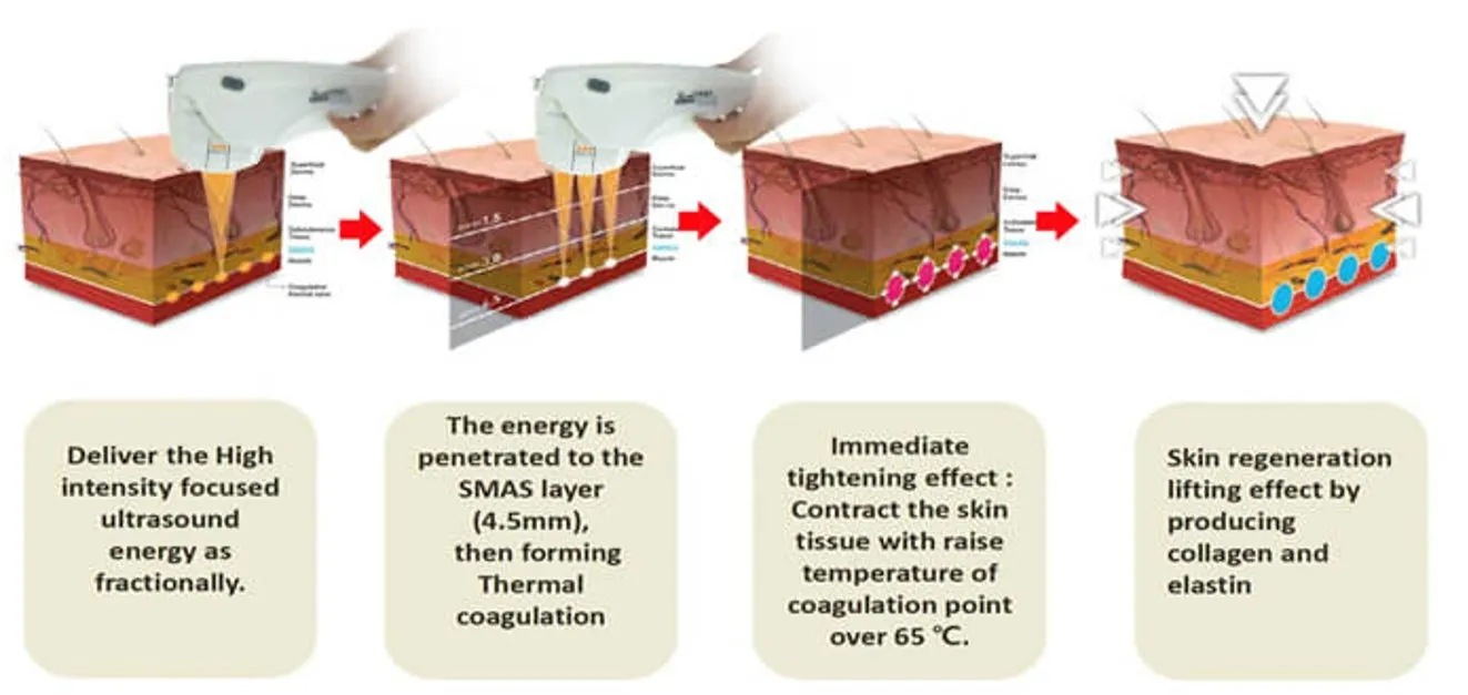9D HIFU Treatment Depth