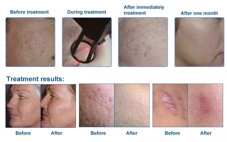 Portable High-Energy Laser CO2 Fractional Laser Pulses Wrinkles Machine