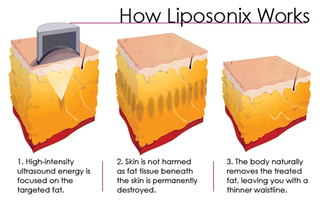 Liposonix Slimming Principle