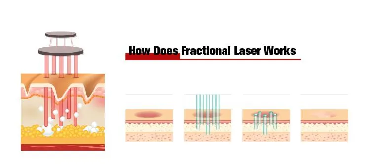 Scars Removal Beauty Machine 60W Fractional CO2 Laser Vaginal Tightening Device