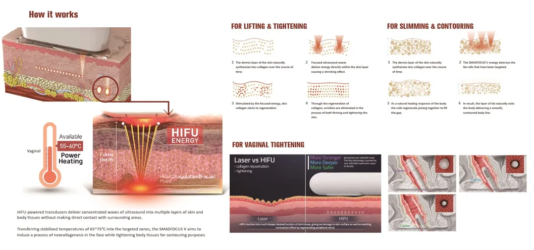 Wrinkle Removal Skin Tightening Hifu RF Skin Tightening Machine