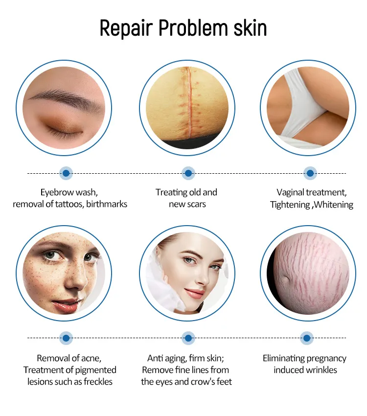 Fractional Laser Scar Removal