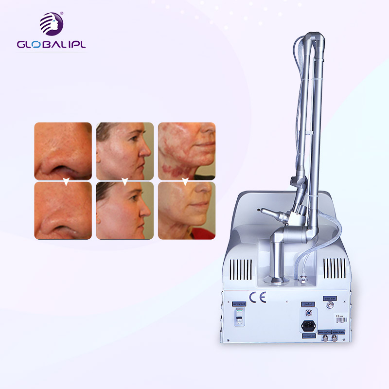 Fractional CO2 Laser Vaginal Rejuvenation