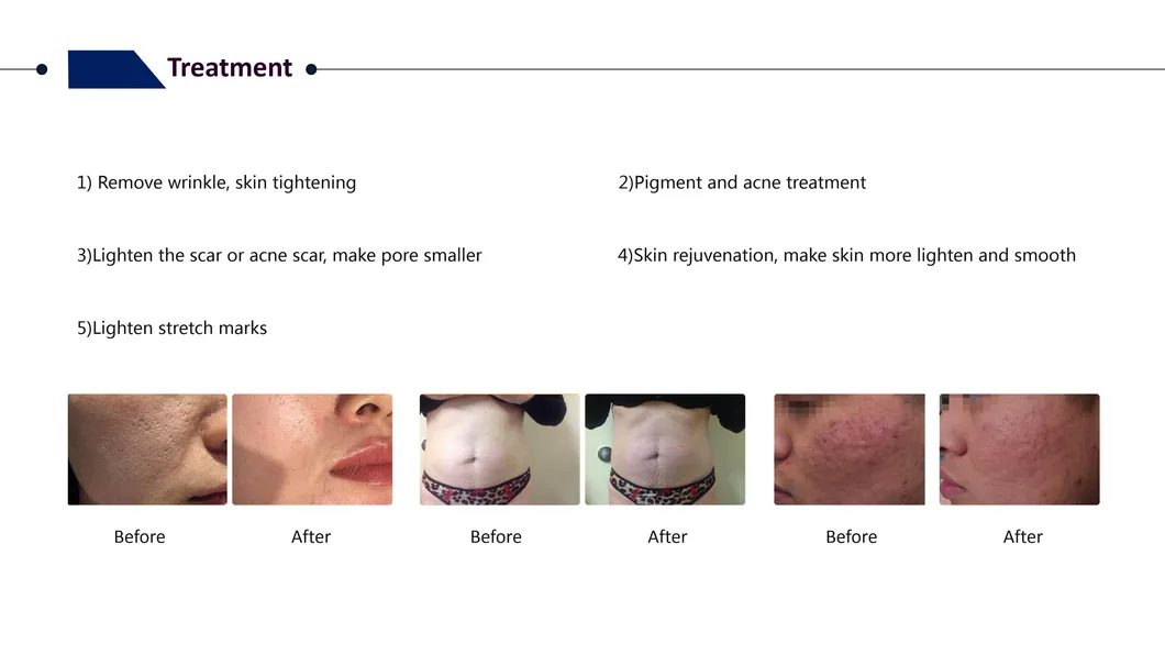 Professional 11 in 1 Hydra Microdermabrasion Facial Care Skin Polishing Hydro Dermabrasion Machine