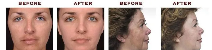 Hydro Dermabrasion Microdermabrasion Machine Diamond Hydra Beauty Facial Machine