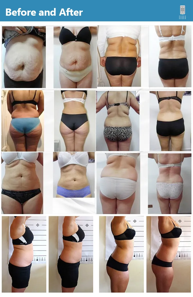 650nm 980nm Body Sculpting Dual Wavelength Diode Laser Liposuction EMS Fat Reduction Slimming Machine