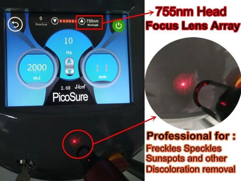 Q Switched Nd Yag Laser Advantages