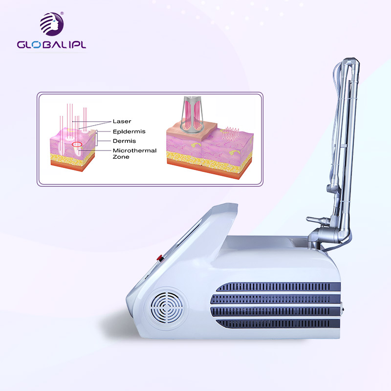 Fractional CO2 Laser Vaginal Rejuvenation