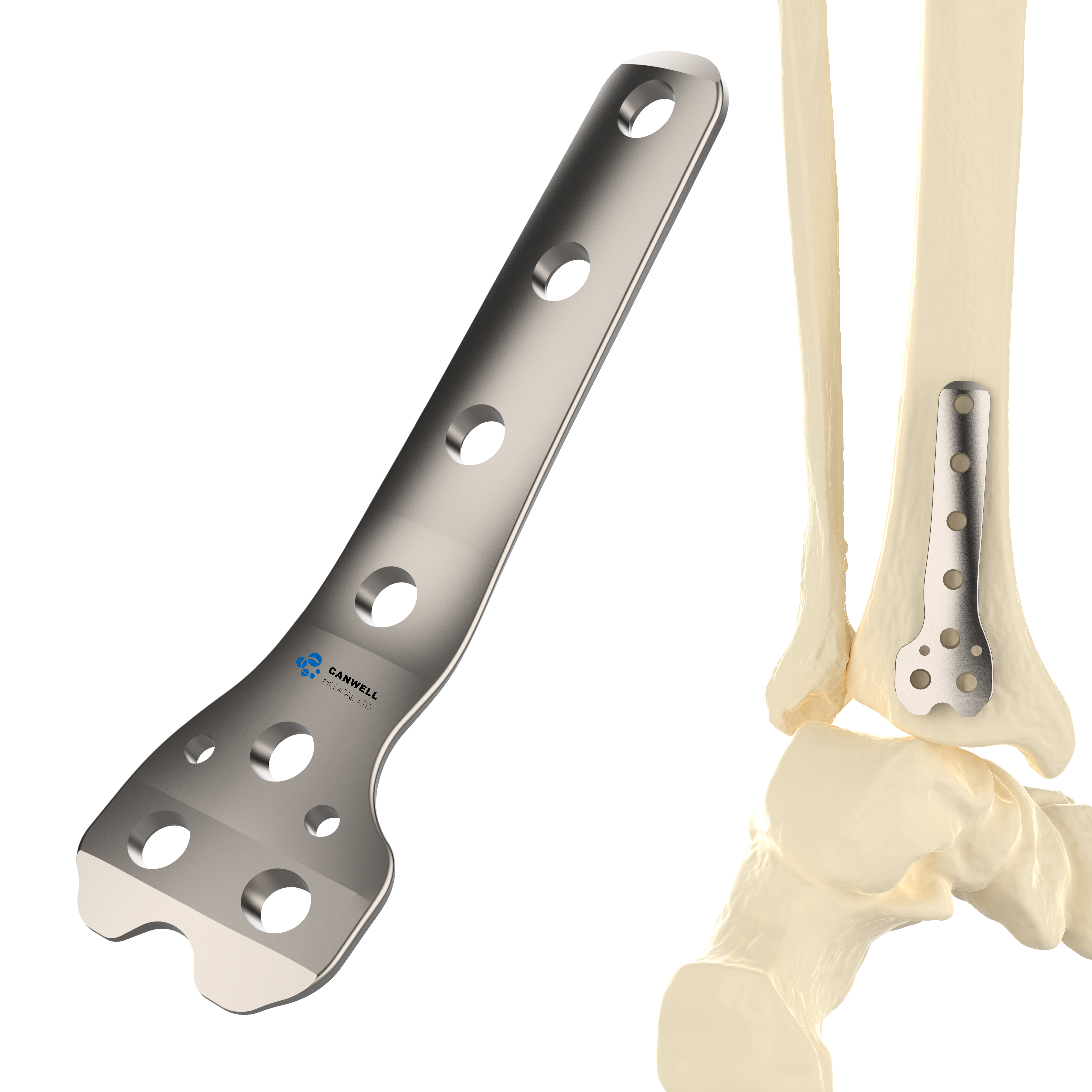 CANWELL Distal Tibial Titanium Locking Plate Posterior Limb Compression Orthopedic Trauma Fracture Implant CE OEM