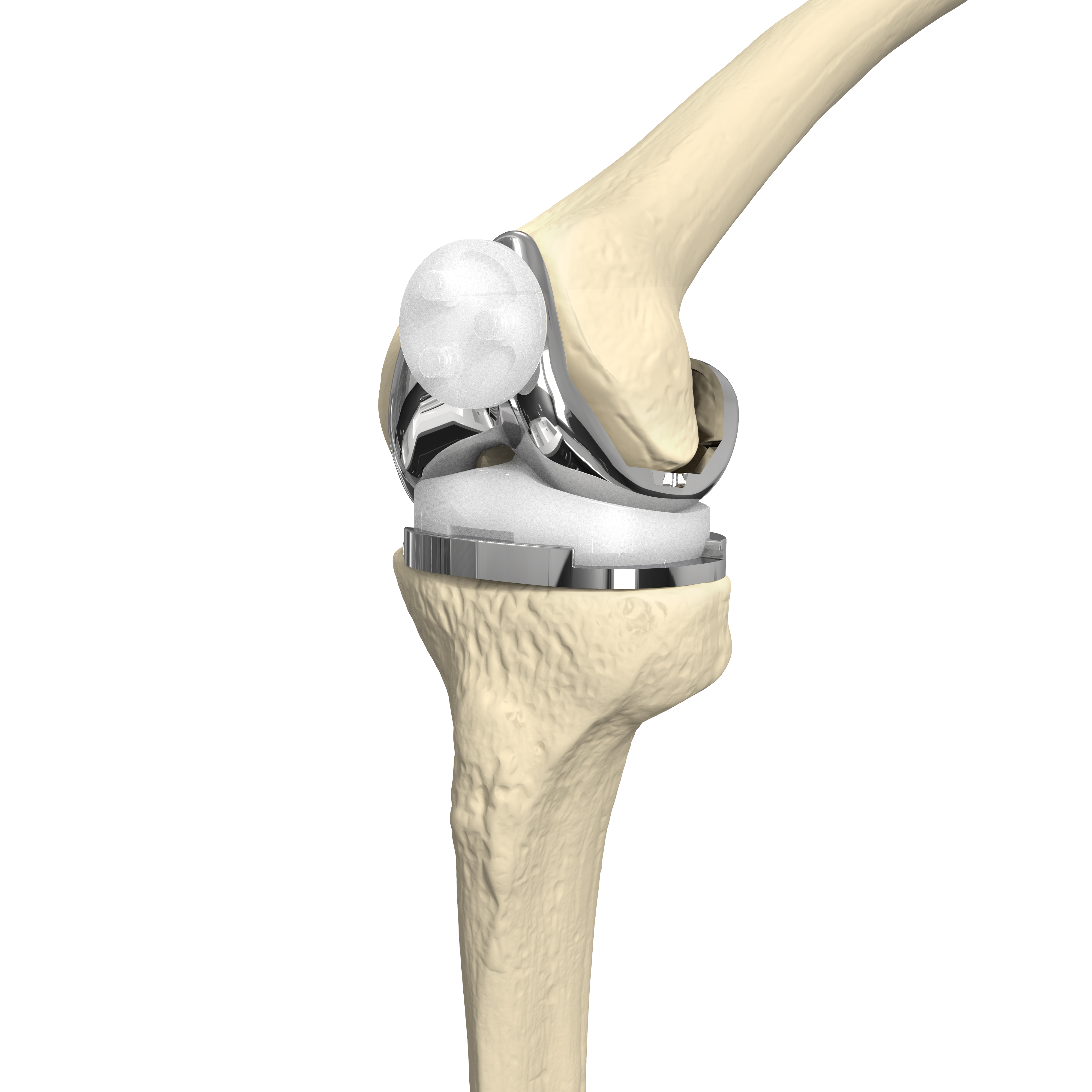 CANWELL Femoral Component Arthroplasty Prosthetic Knee Joint Prosthesis Artificial PS CoCrMo Primary Total Knee Replacement Kit