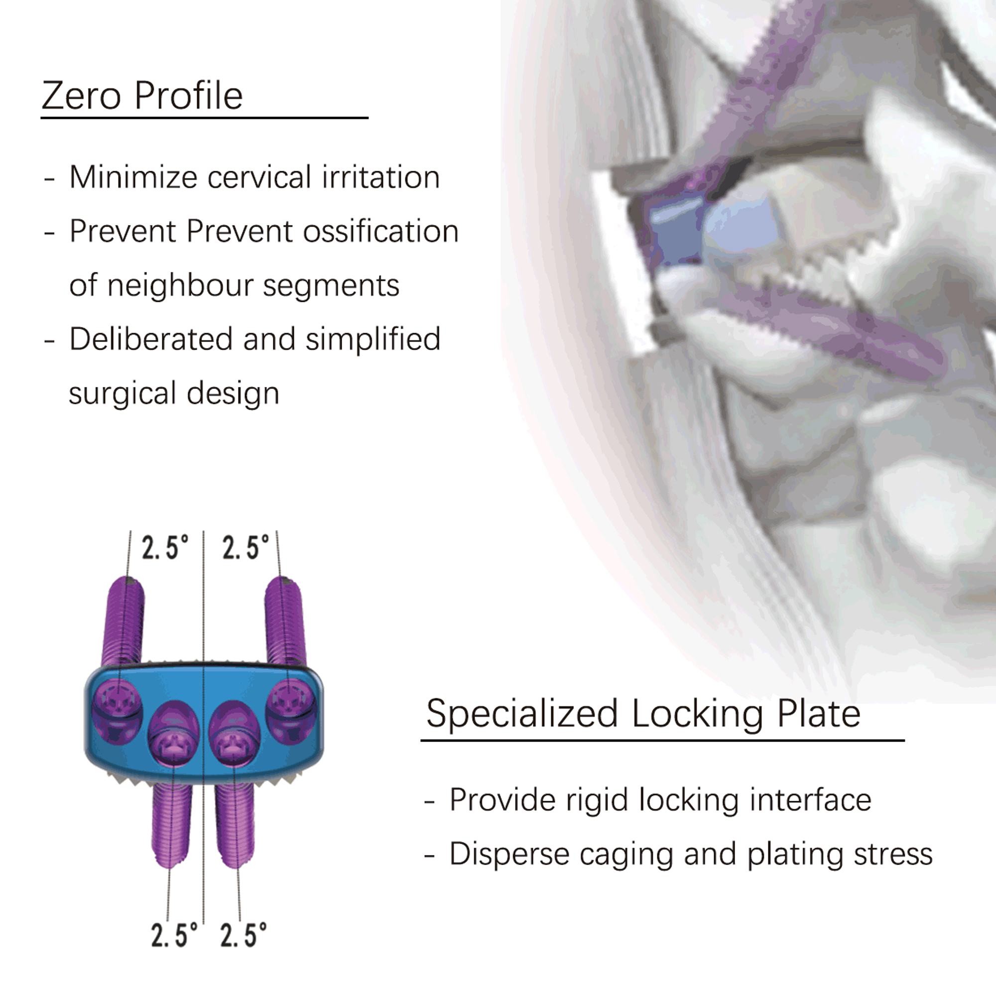 CANWELL PEEK Zero Profile Cervical Fusion Cage Anterior Cervical Interbody Implant for ACDF Spine Surgery System