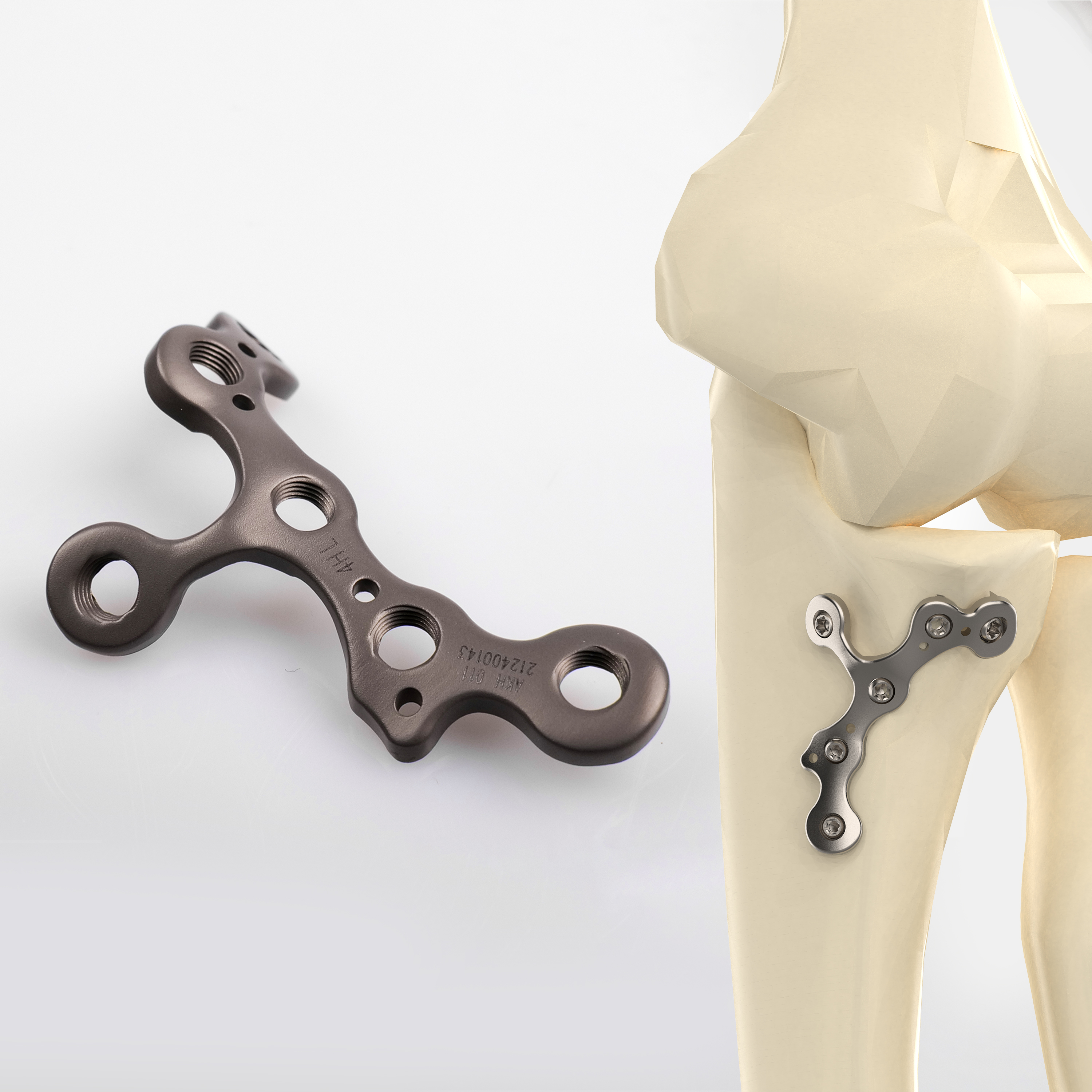 CANWELL Proximal Ulnar Radius Plate Titanium Locking Plate Volar Wrist Orthopedic Trauma Implant Bone Fracture