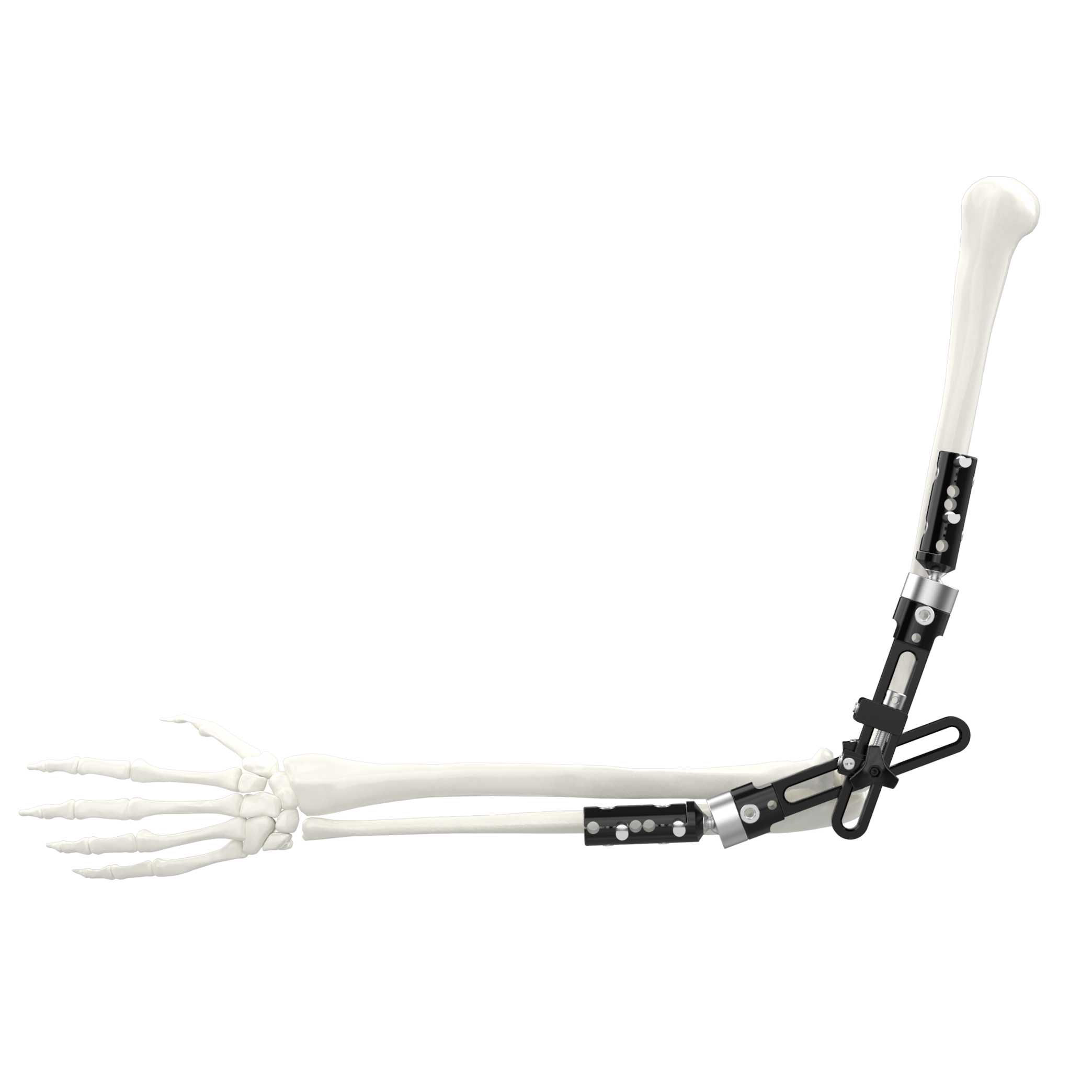CANWELL Orthopedic Trauma Implant Ilizarov Ring Fixator External Fixator Ilizarov External Fixation