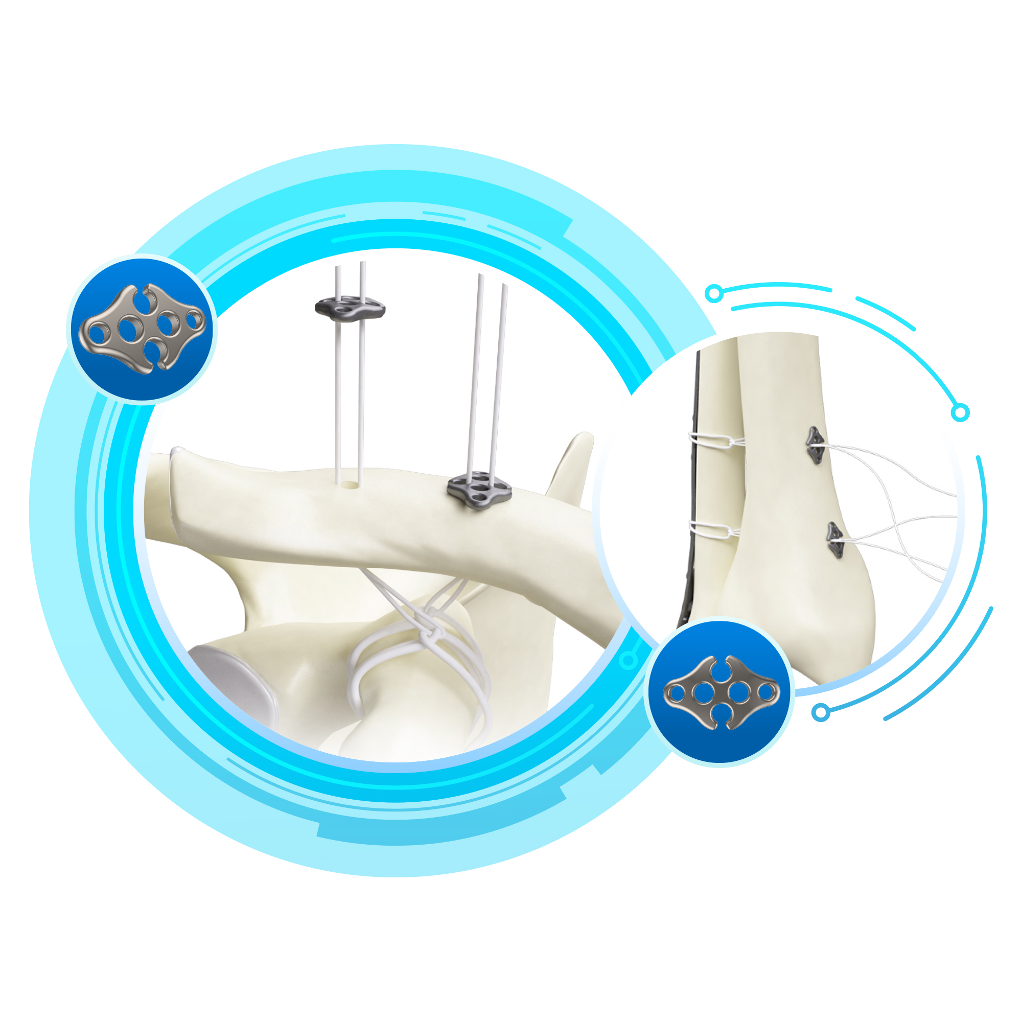 CANWELL Arthroscopy Button Acromio Clavicular Joint Button AC Repair Button Orthopedic Sports Medicine