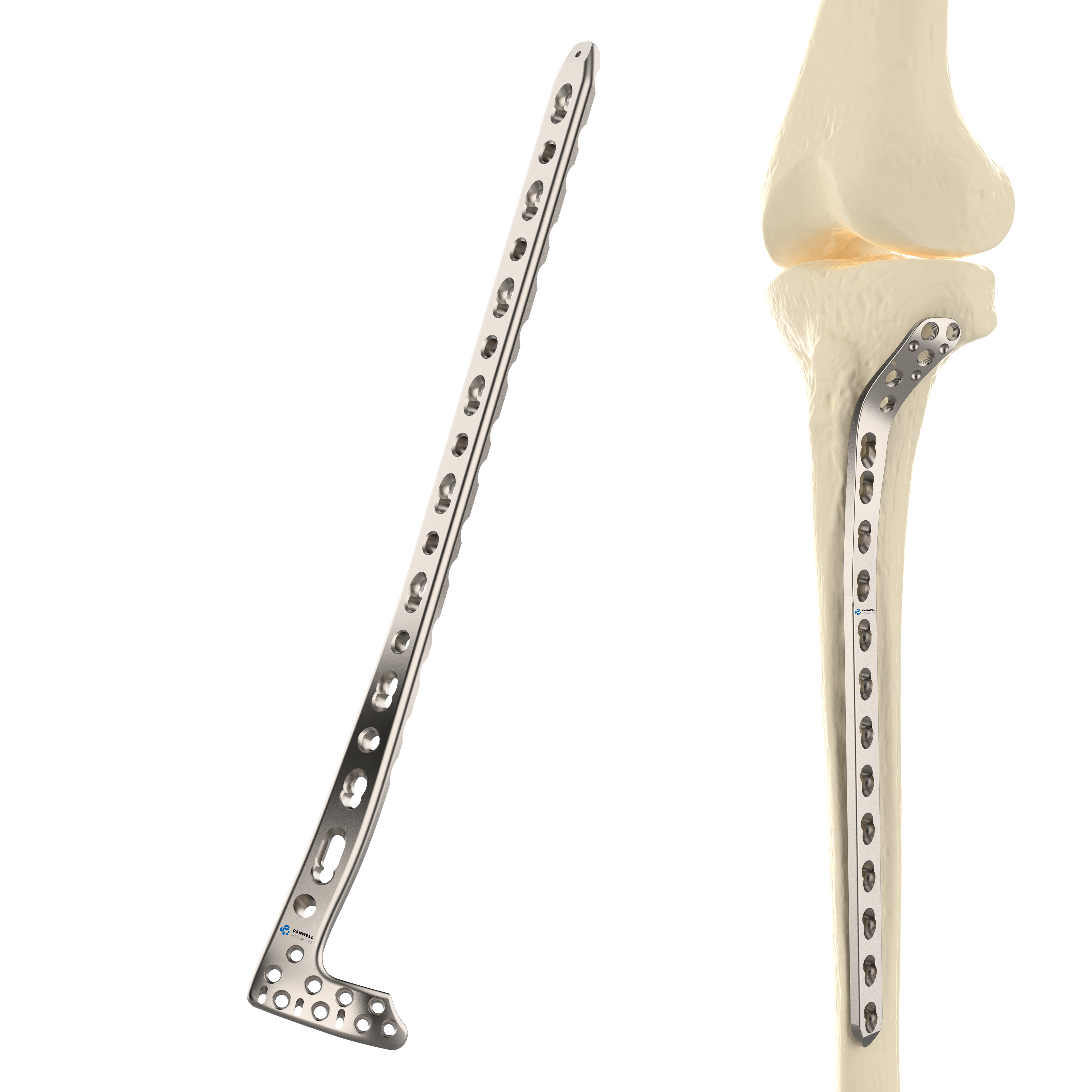 CANWELL  Distal Tibial Low Profile Locking Plate Titanium Metaphyseal Compression Fixation System Orthopedic Trauma CE ISO