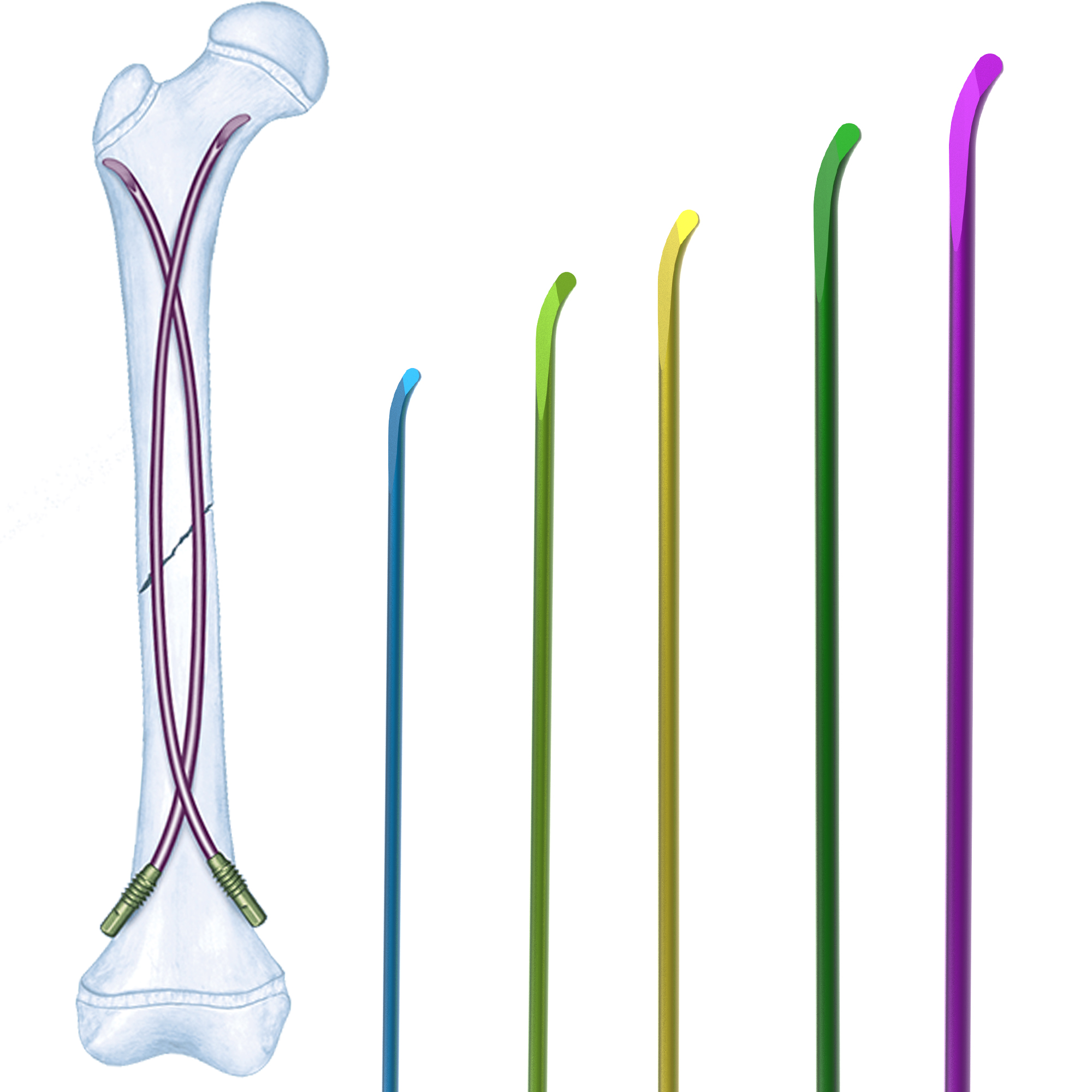 Canwell Titanium Elastic Nail Intramedullary Nail Femur Telescopic Flexible Pediatric Orthopedic Implant Fractures Surgery