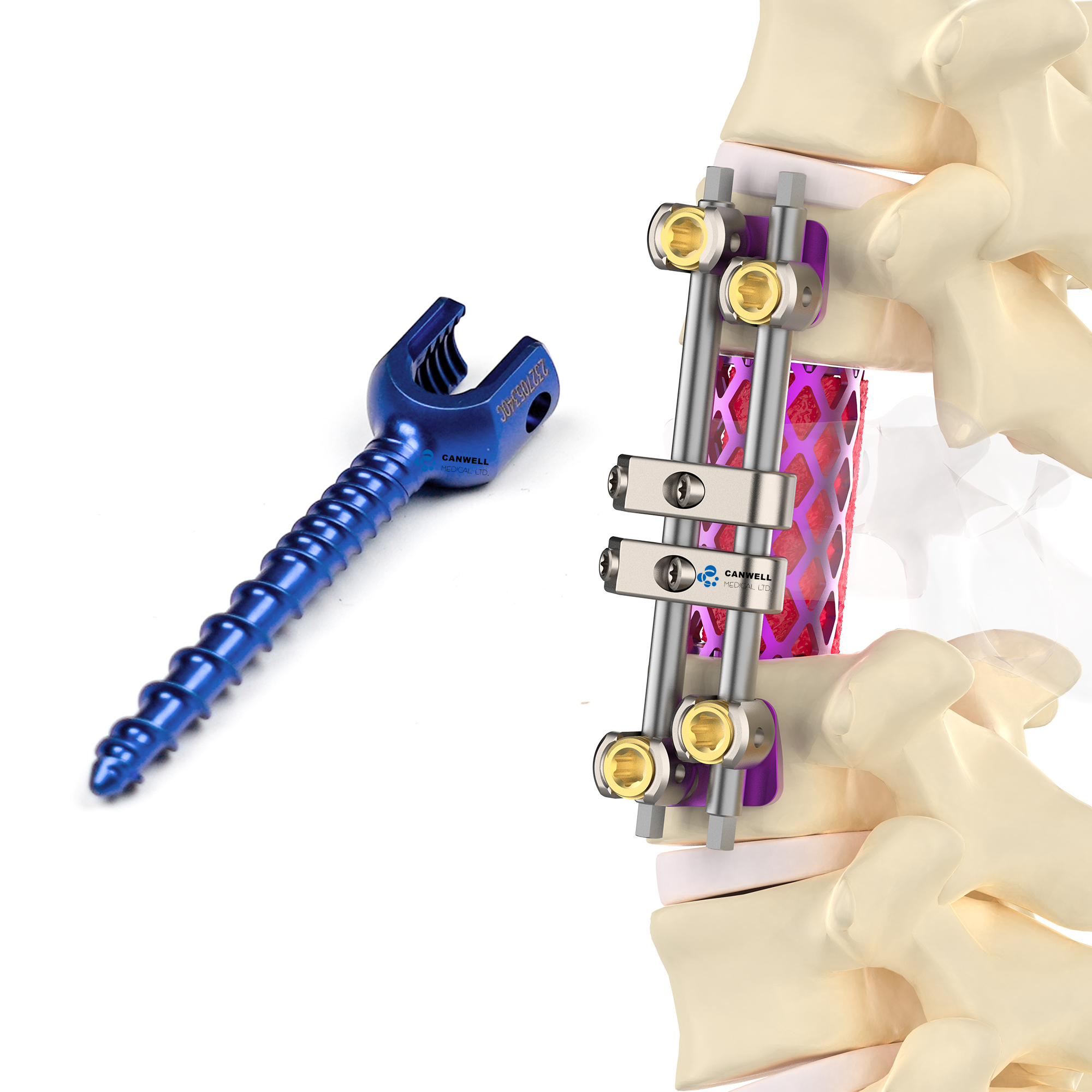 CANWELL Anterior Thoracolumbar Pedicle Screw Polyaxial Reduction Pedicle Spine Screw Minimally Invasive Systems for Lumbar Spine