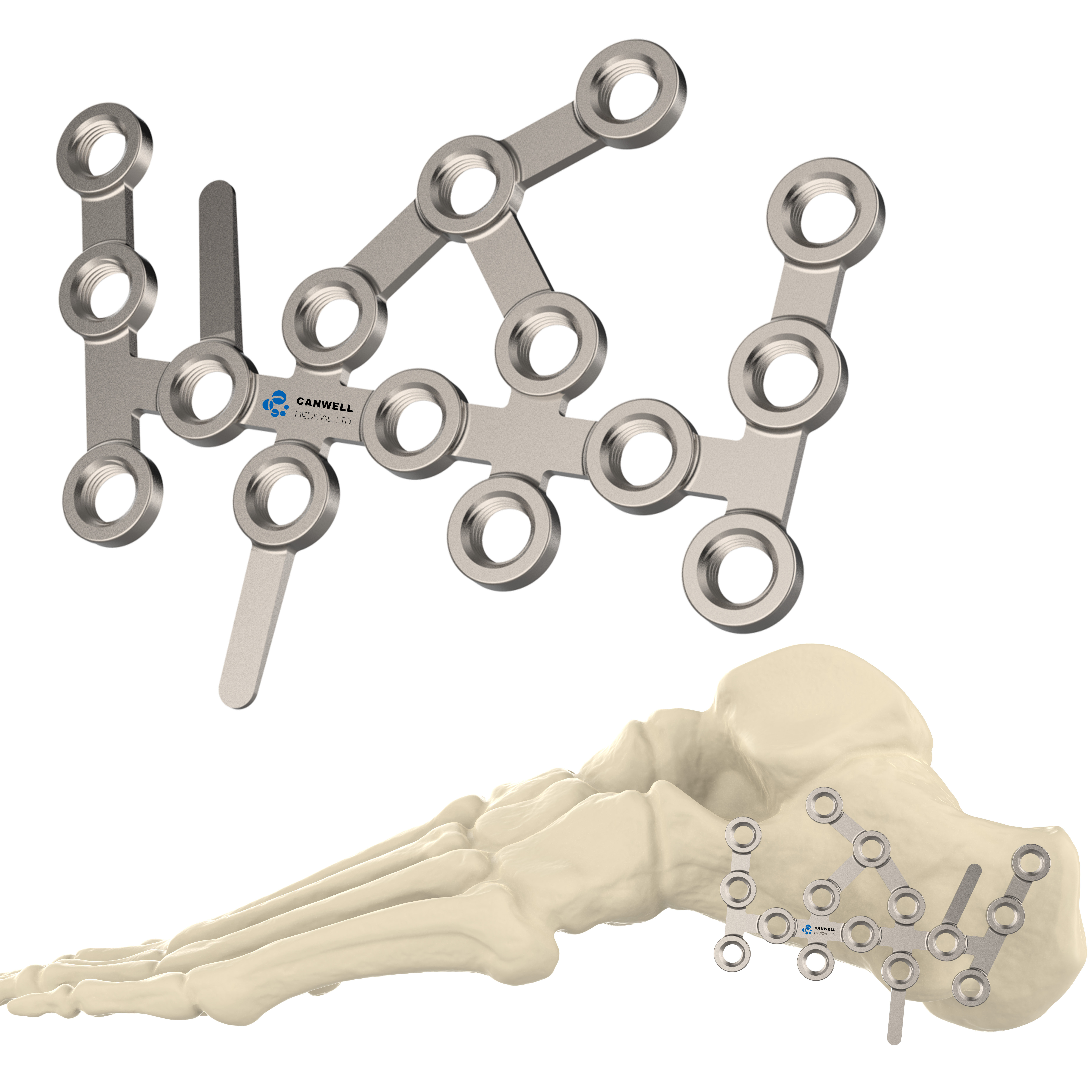 CANWELL Calcaneal Titanium Locking Plate Foot and Ankle Trauma Implant Orthoepedic Fracture Surgery CE ISO