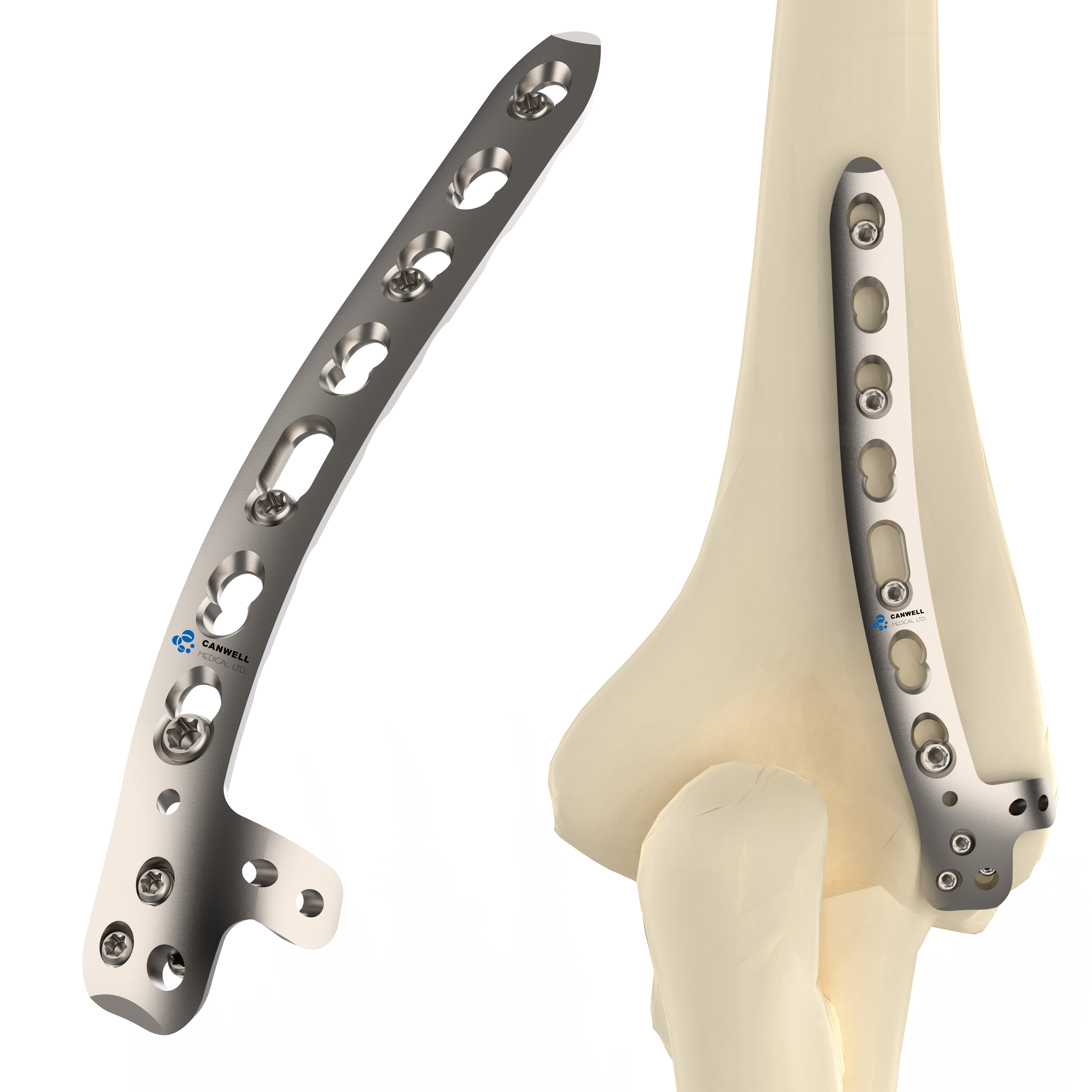 CANWELL Humeral Locking Plate Titanium Distal Lateral Dorsal Elbow Fracture Fixation Orthopedic Trauma Implant OEM Supplier