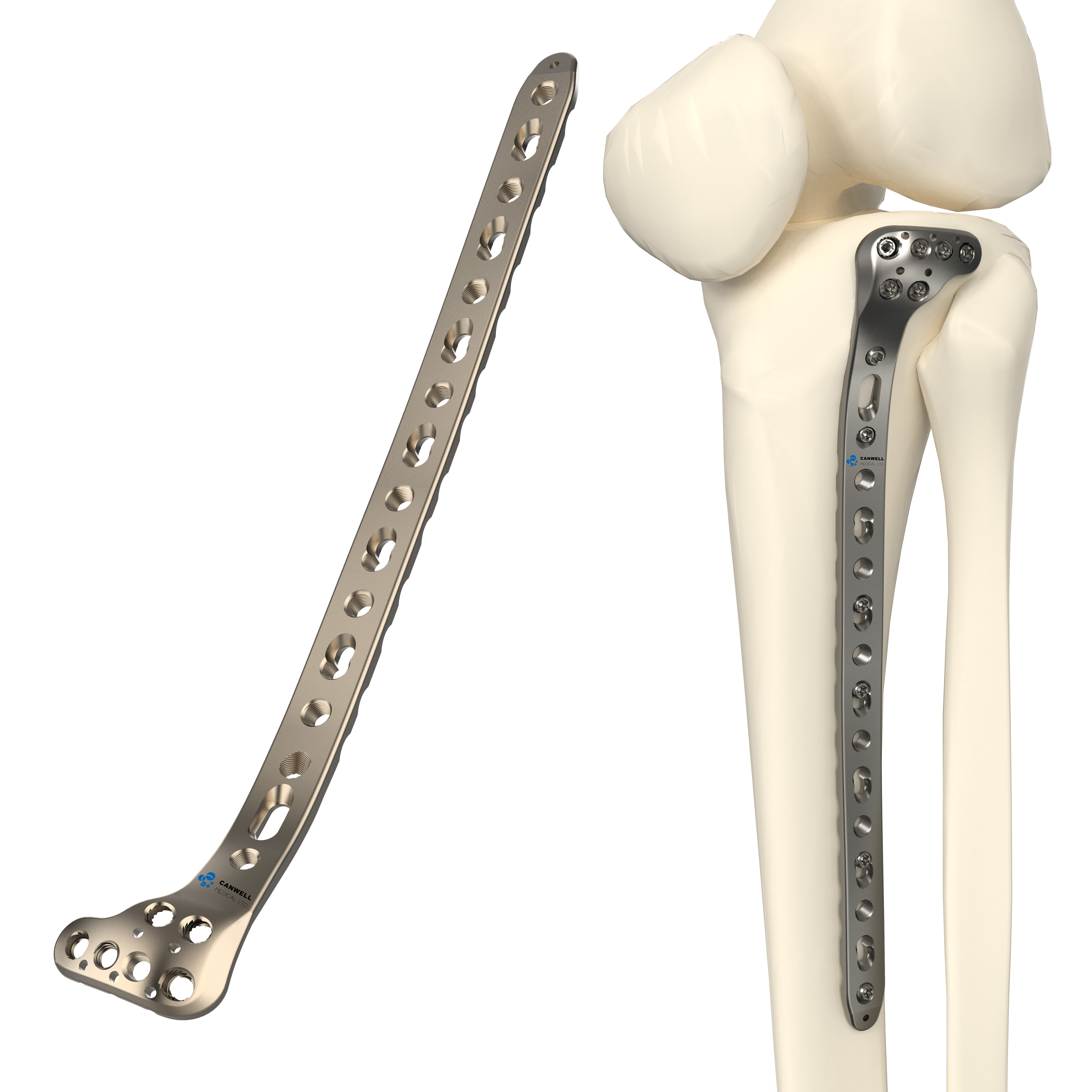 CANWELL  Titanium Proximal Tibial Locking Plate for Tibial Plateau Fracture Fixation 3.5/4.5mm Orthopedic Trauma Implant