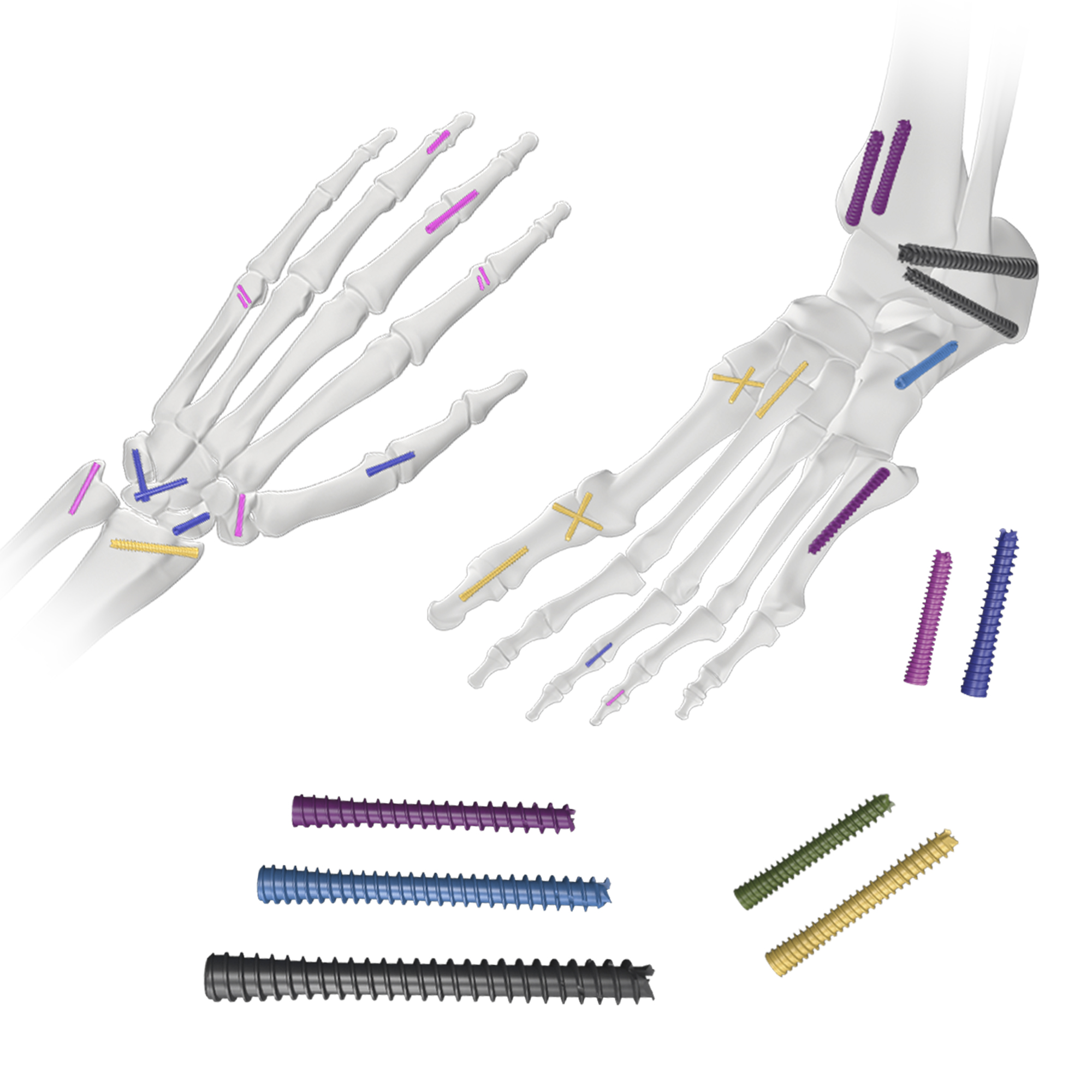 CANWELL Titanium Headless Cannulated Compression Screws Orthopedic Trauma Implant System CE Certified