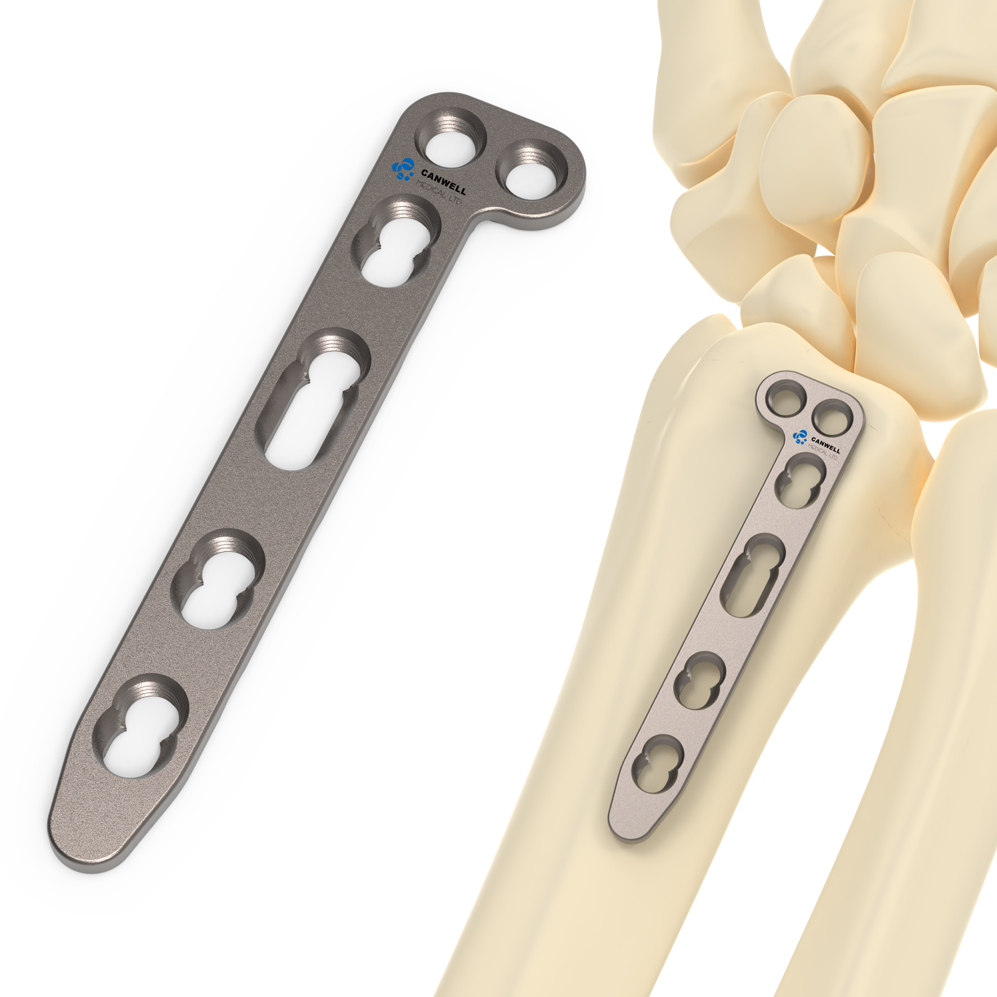 CANWELL Distal Radius TItanium Locking Plate Volar Wrist Orthopedic Trauma Implant Bone Fracture Suppliers Manufacturer CE ISO