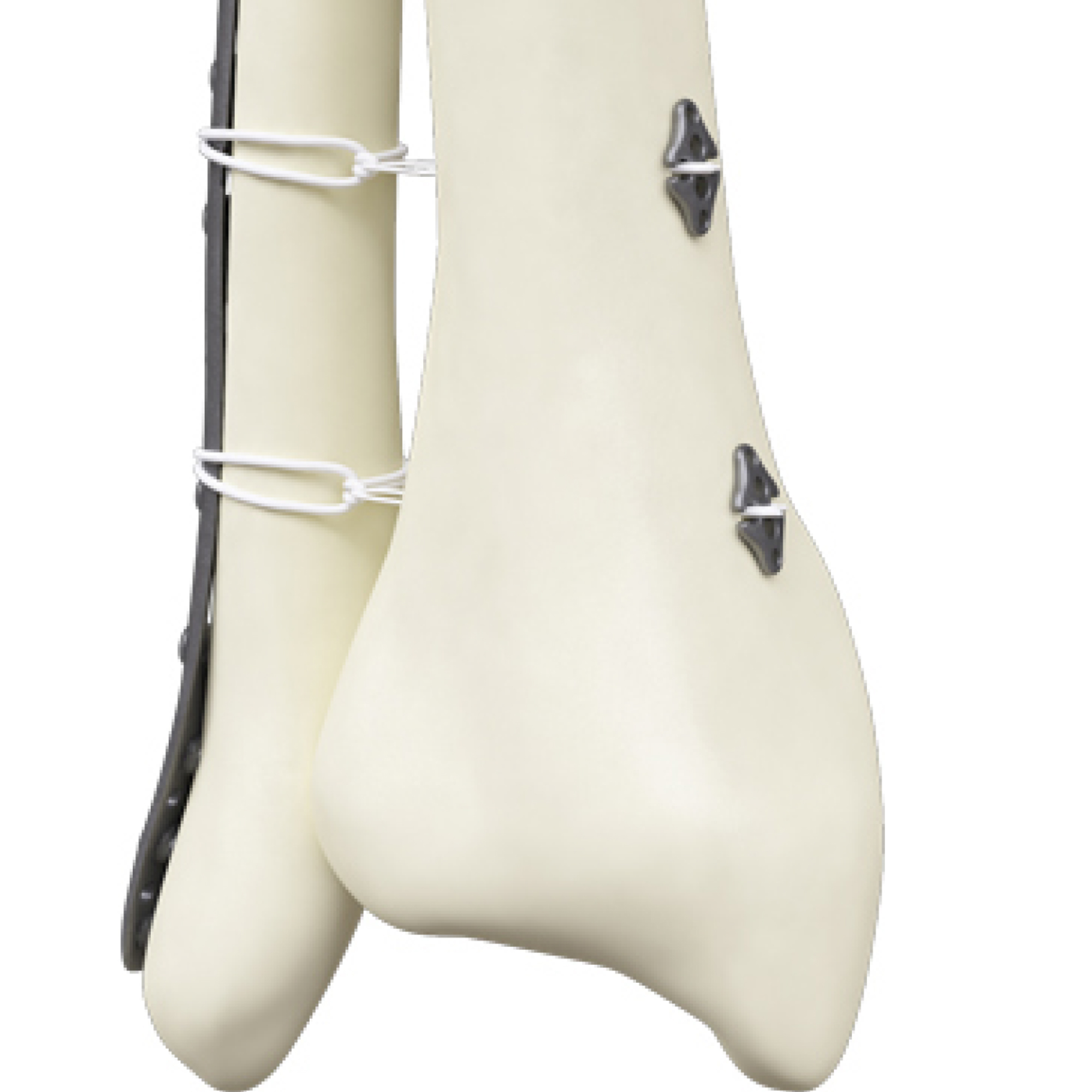 CANWELL Arthroscopy Button Acromio Clavicular Joint Button AC Repair Button Orthopedic Sports Medicine