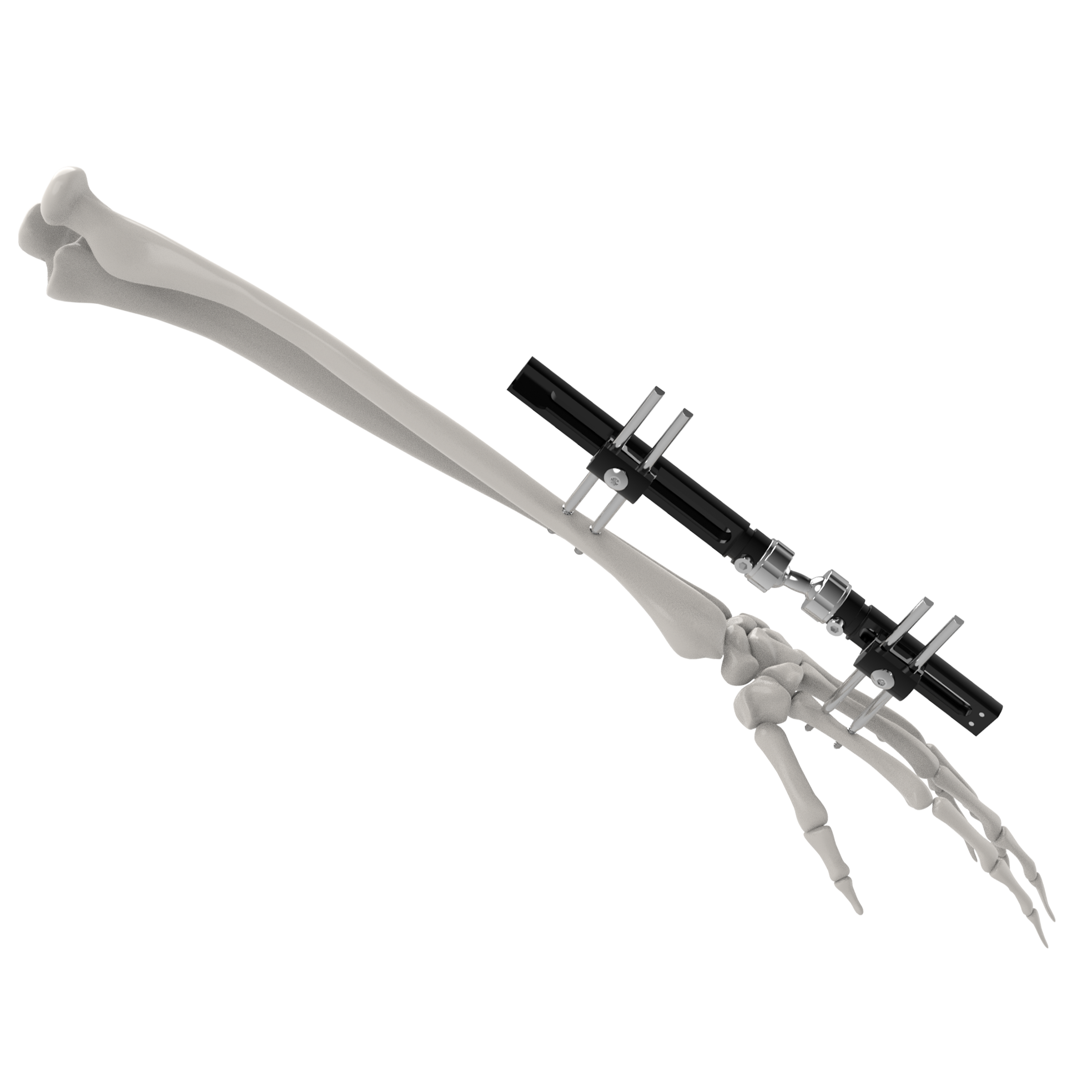 CANWELL Wrist External Fixator Small Bones Fracture Fixation Mini External Fixator Orthopedic Implant Phalanges and Metacarpals